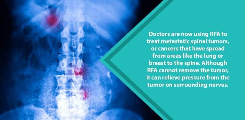 image of spine with metastatic spine cancer from lung