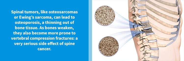 Osteosarcomas and Ewing's sarcoma can lead to osteoporosis of the spine (pictured here).