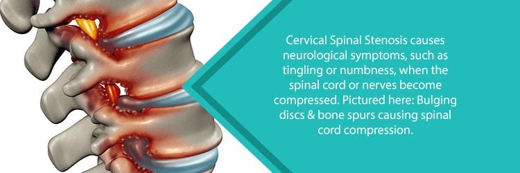 image of cervical spinal stenosis and spinal cord compression from bone spurs