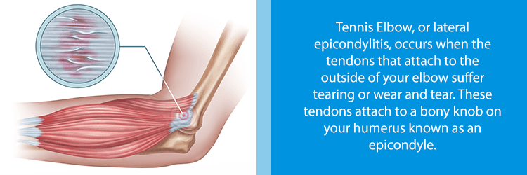 Image of elbow with torn tendons from lateral epicondylitis