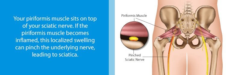 graphic of piriformis muscle pinching the sciatic nerve