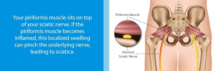 Understanding The Origin of Piriformis Syndrome and Sitting