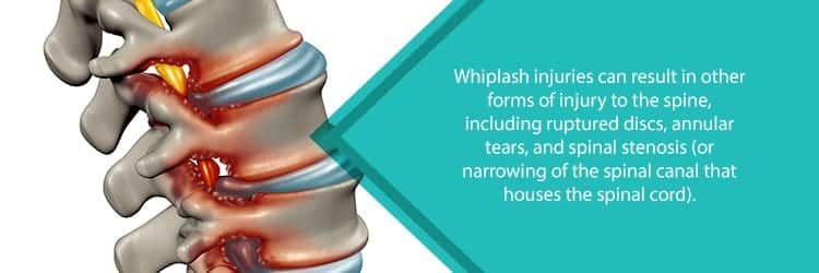 spinal stenosis from whiplash injury