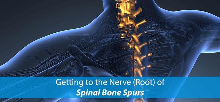 spinal bone spurs