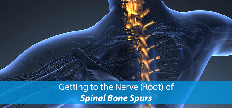 Getting to the Nerve (Root) of Spinal Bone Spurs | NJSO