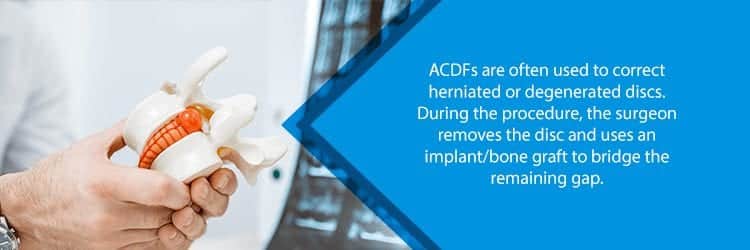 ACDF for herniated/degenerated disc