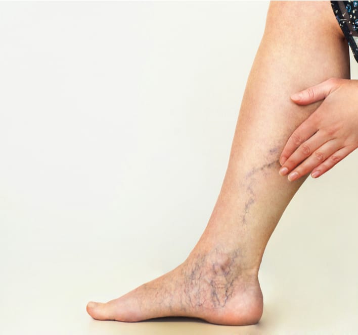top facts for varicose veins