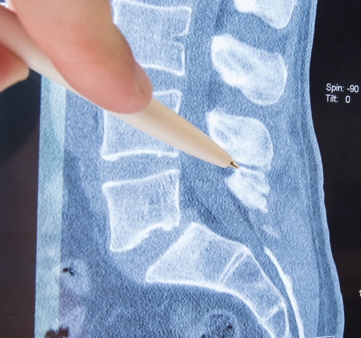 XStop Spinal Surgery New Jersey NJ Spine & Orthopedic