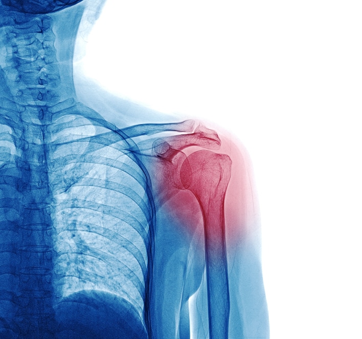 X ray of inflamed shoulder
