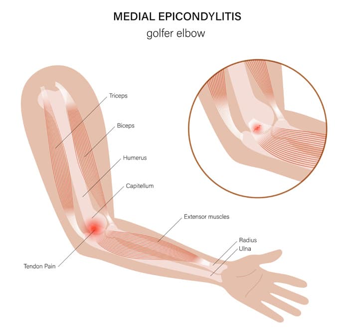 Pain in discount inner elbow
