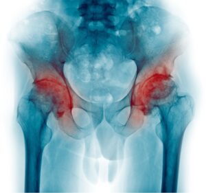hip joints