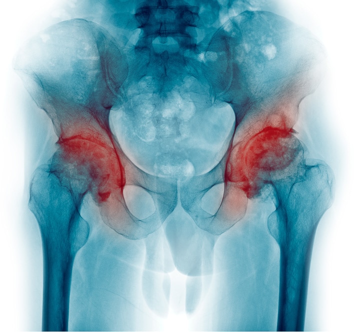 hip joints