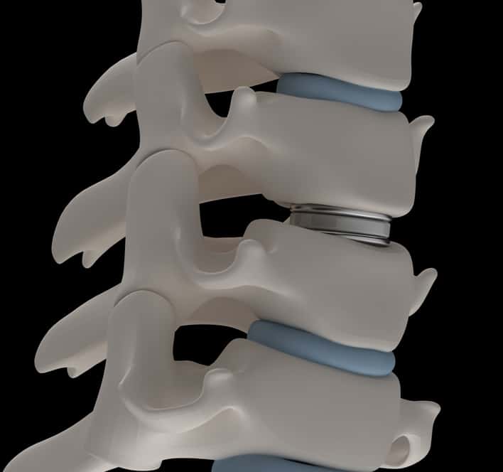 Artificial intervertebral disc prosthesis