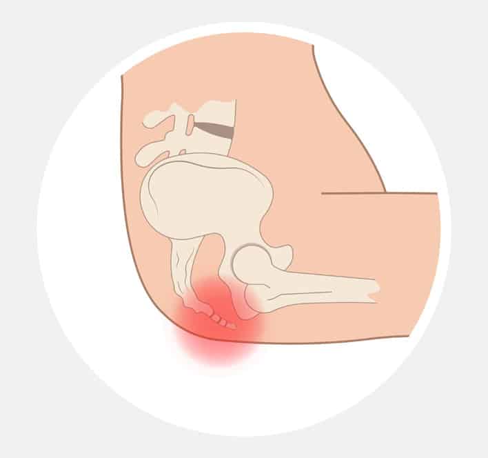 Tailbone Pain (Coccydynia): Symptoms, causes, prevention, diagnosis,  treatment