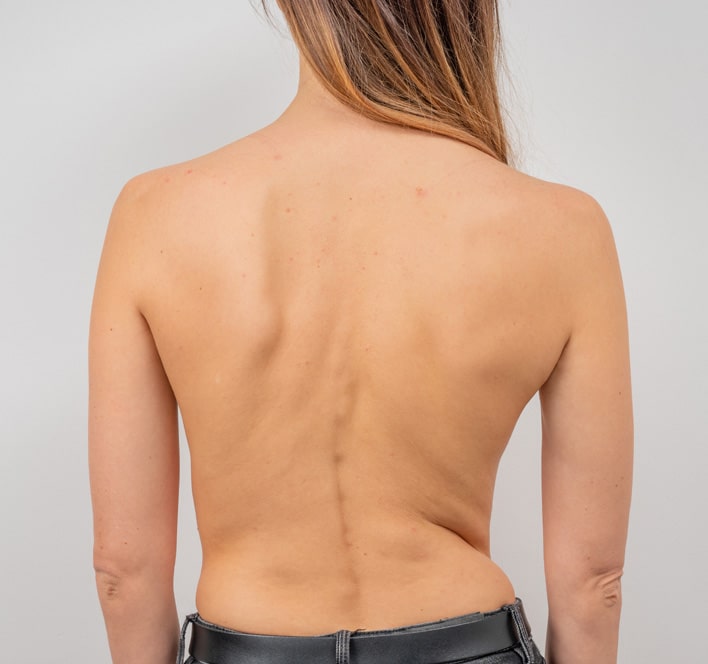 Woman with scoliosis of the spine