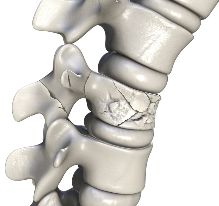 https://www.njspineandortho.com/wp-content/uploads/2023/07/Spinal-fracture.jpg
