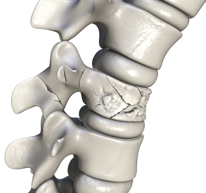 Average Compensation For Fractured Sternum La Puente thumbnail