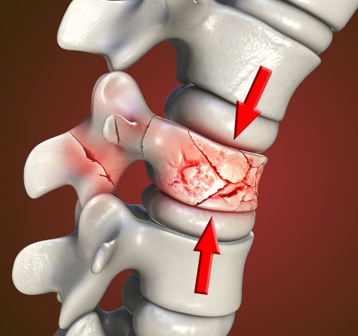 How Is a Spinal Compression Fracture Treated?