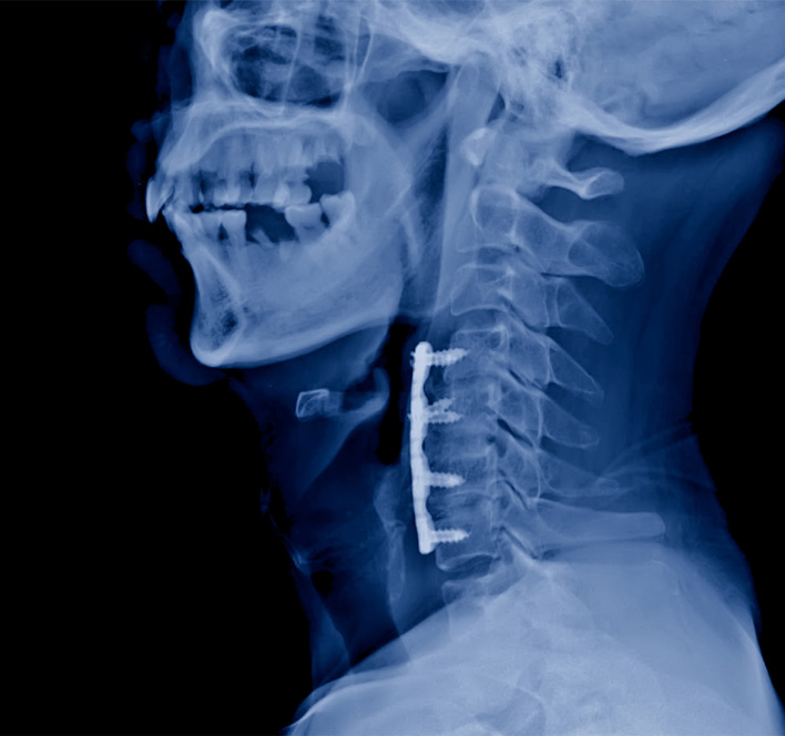 cervical spine x-ray