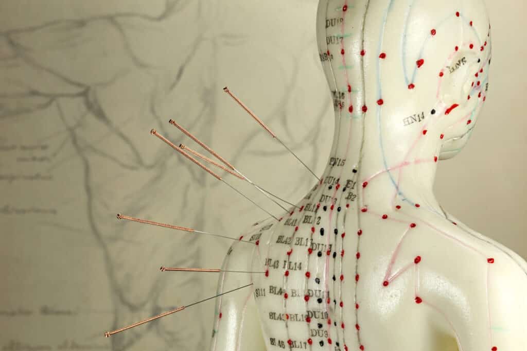 female acupuncture model with needles in the shoulder