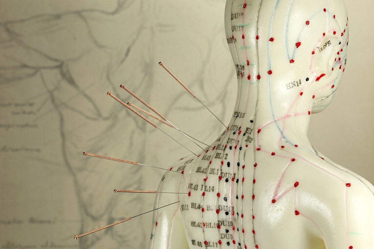 female acupuncture model with needles in the shoulder